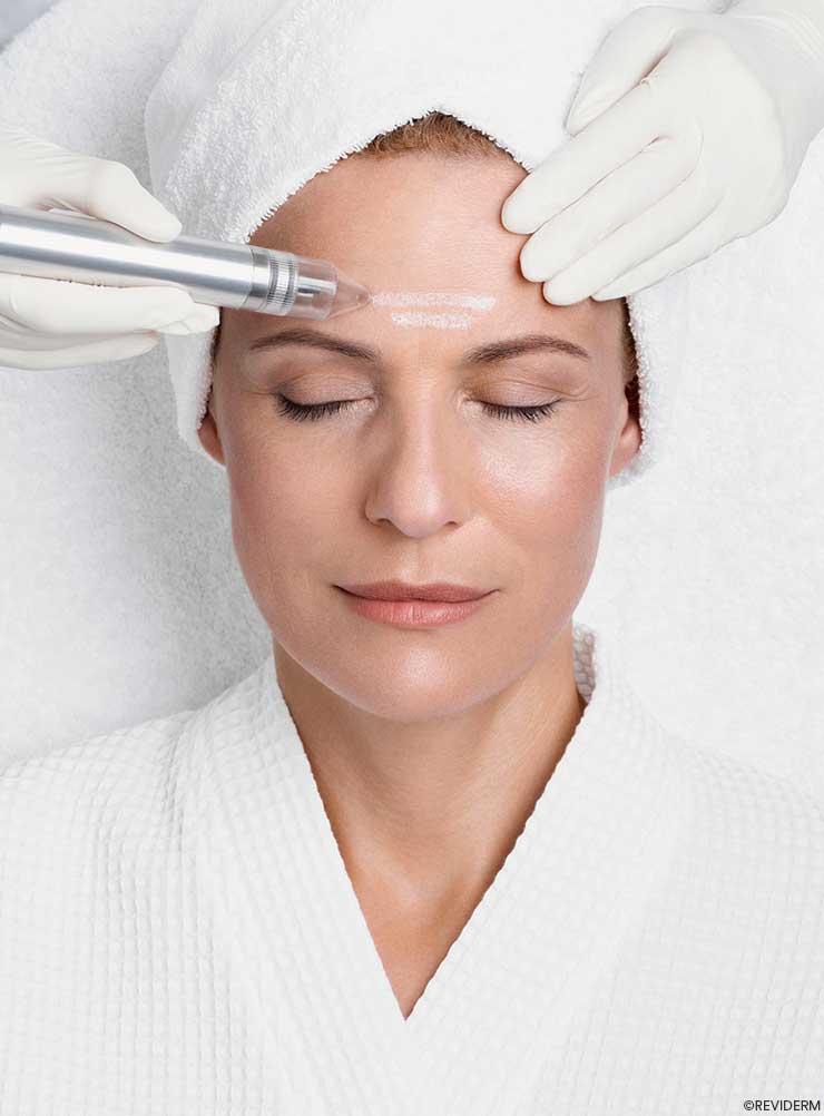 mikrodermabrasion 1